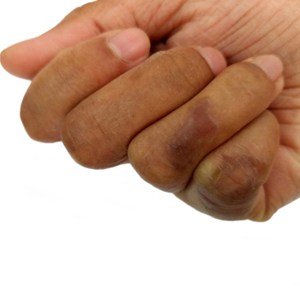 brandwond op hand