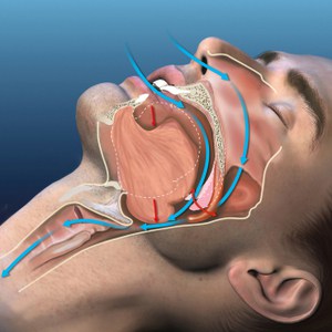 illustration médicale du ronflement