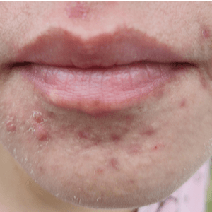 acne op kin van vrouw