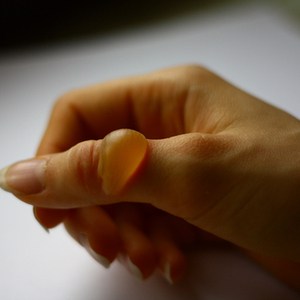 brandblaar op vinger