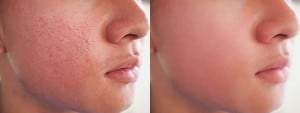 Afbeelding voor en na plek rood litteken acne puistje behandeling op een gezicht Aziatische man. Probleem huidverzorging en gezondheidsconcept.
