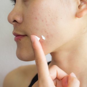 crème tegen acne