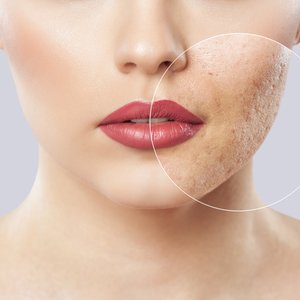 acne littekens