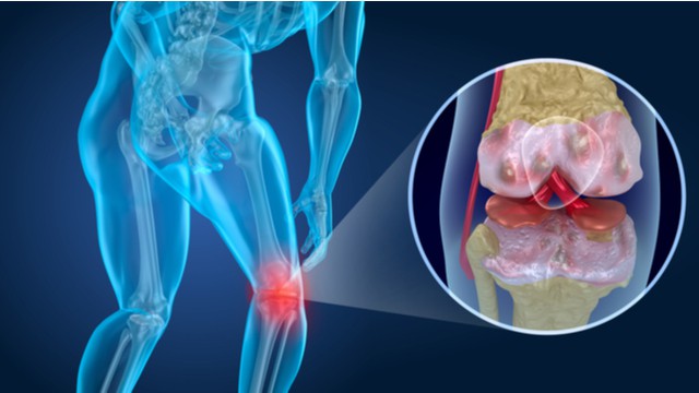 oorzaak artrose in de knie