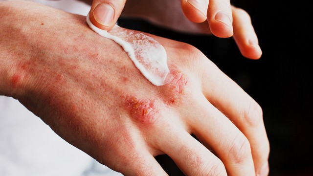 pommade contre l'eczéma