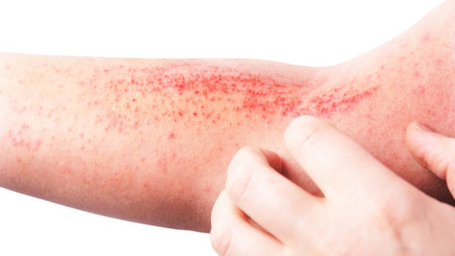symptômes de l'eczéma