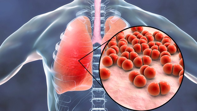 cause de la pneumonie