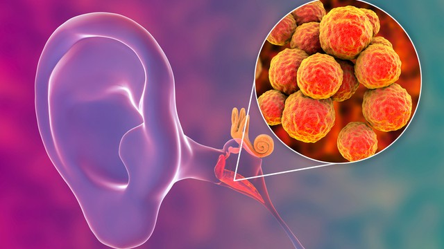 Otitis media