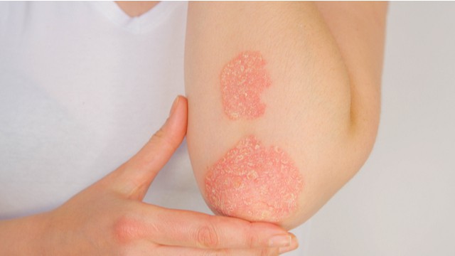 Symptômes du psoriasis