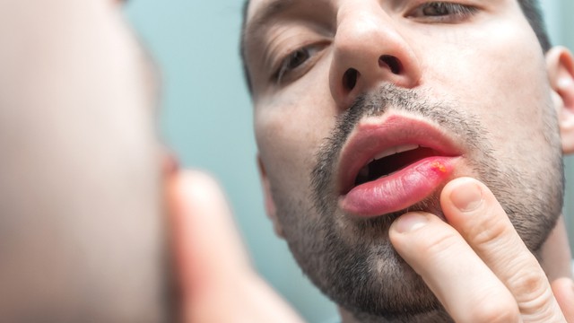 Cause des boutons de fièvre