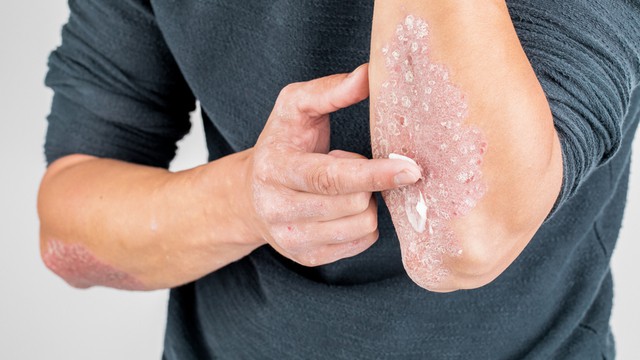 Psoriasis behandeling
