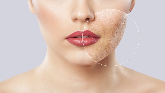 acne littekens