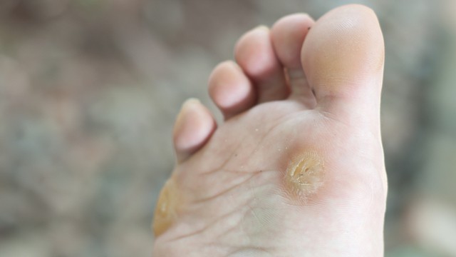 corne au pied