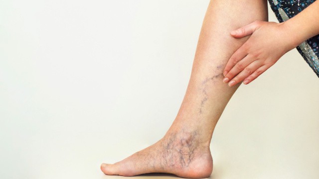 prévenir les varices