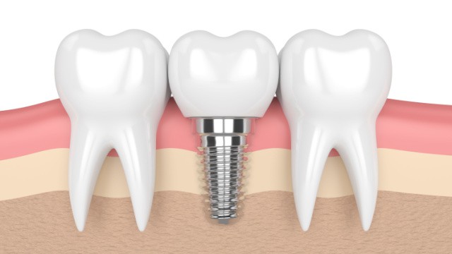 couronne sur implant