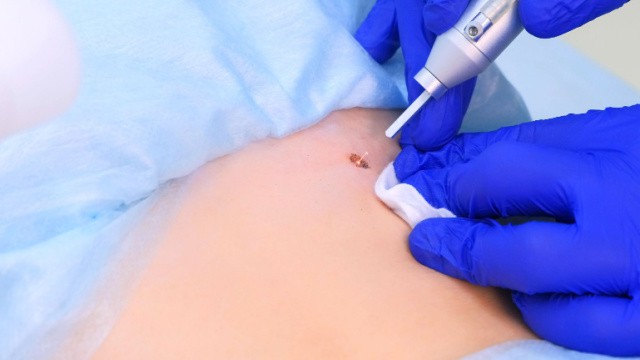faire enlever la tache de naissance