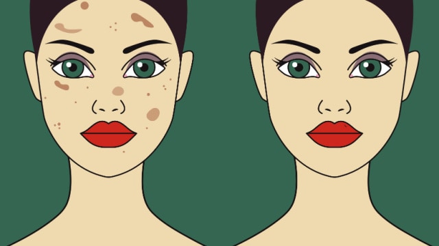 Taches d'hyperpigmentation