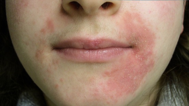 Symptômes de la dermatite périorale