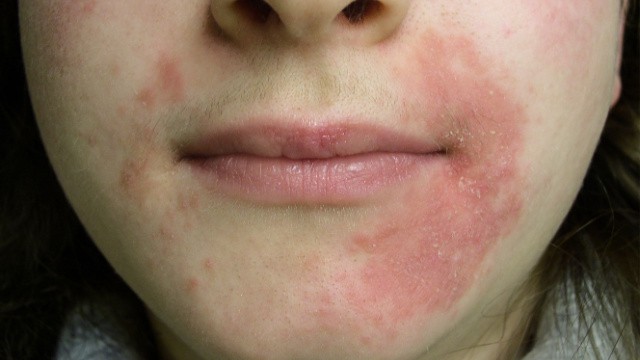 Dermatitis perioralis symptomen