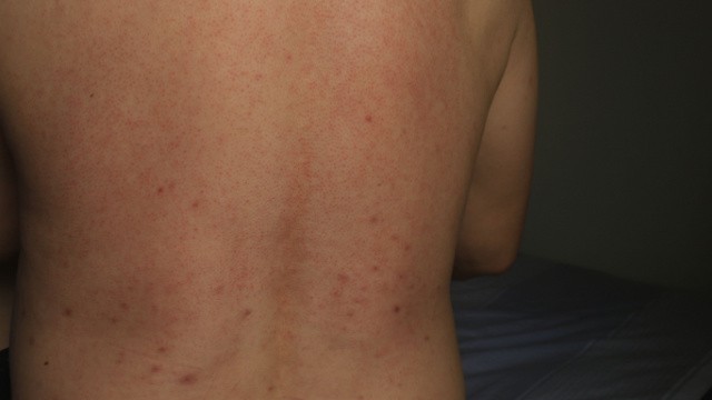 causes des boutons sudoripares