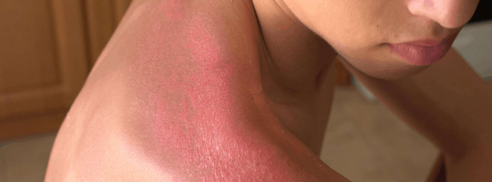 Que faire en cas de coup de soleil?