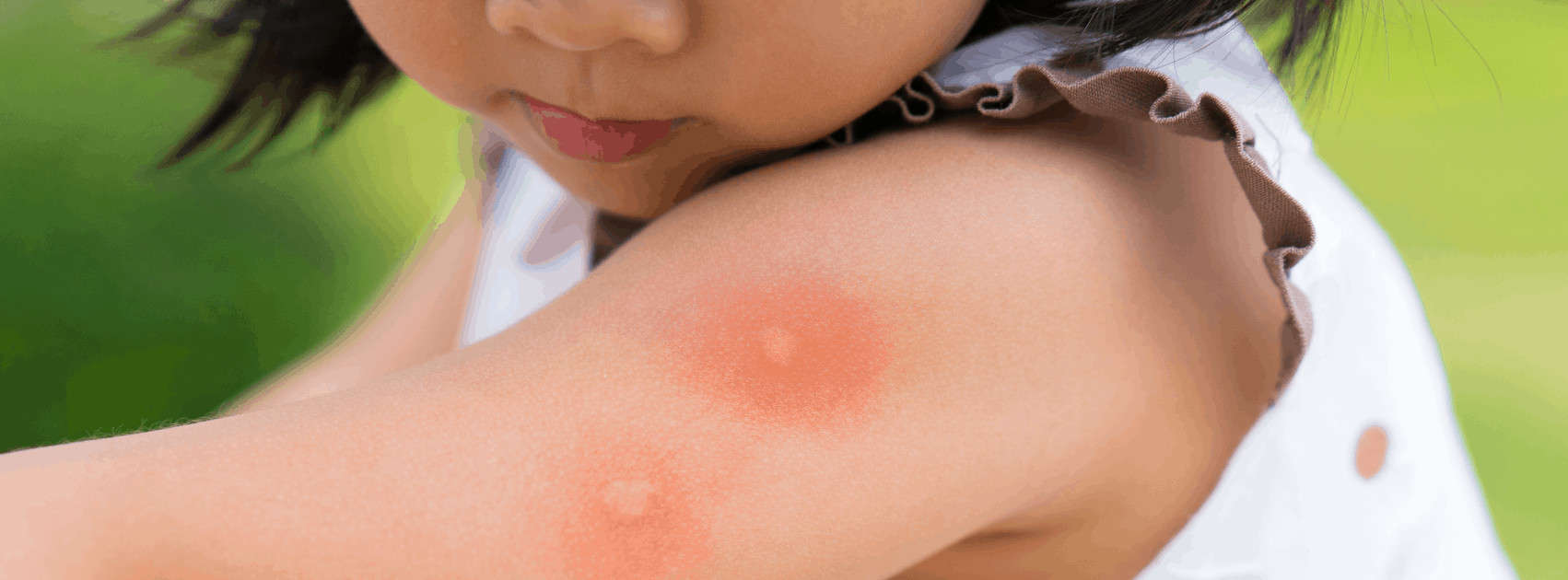 Protection et traitement des piqûres d'insectes