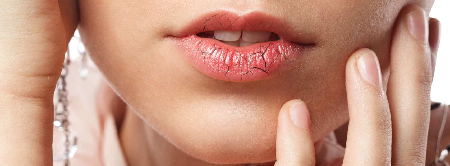 10 tips tegen droge lippen
