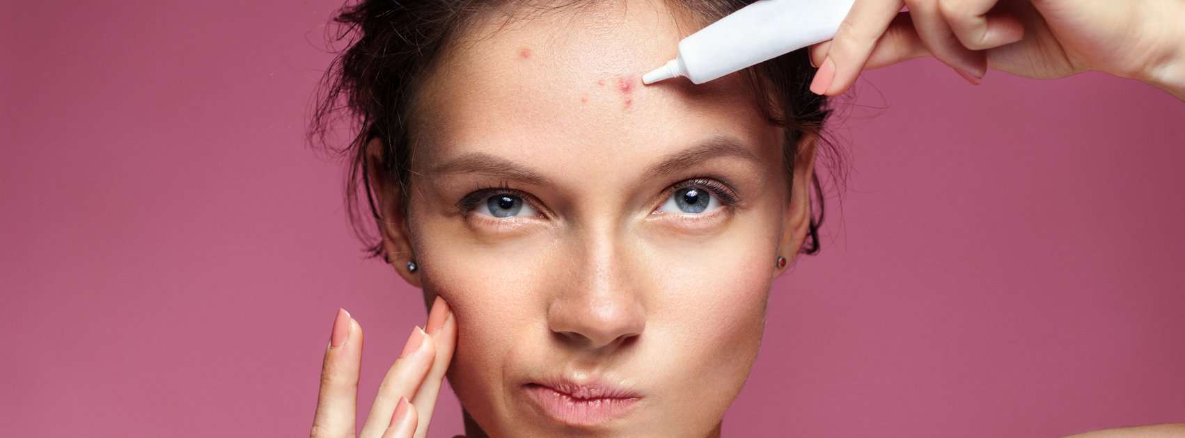 Acne voorkomen en behandelen