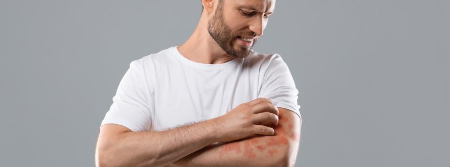Wat doen bij Psoriasis?