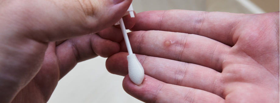Traiter des verrues sur les pieds ou les mains