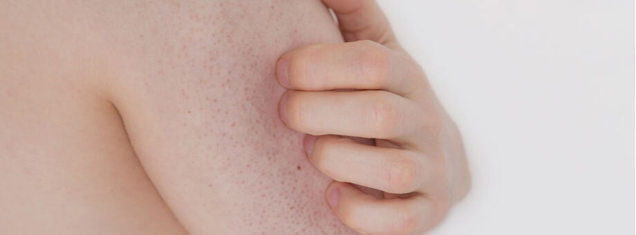 Alles wat je moet weten over keratosis pilaris