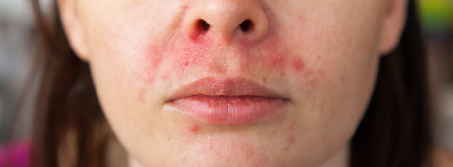 Wat is dermatitis perioralis en hoe behandelen?