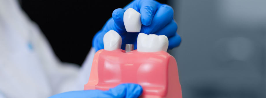 Ce qui est important lors de la pose d'un implant dentaire ?