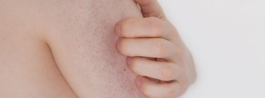 Tout ce que vous devez savoir sur la kératose pilaire
