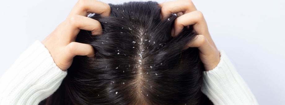 Que faire contre les pellicules ?