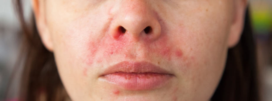 Qu'est-ce que la dermatite périorale et comment la traiter ?