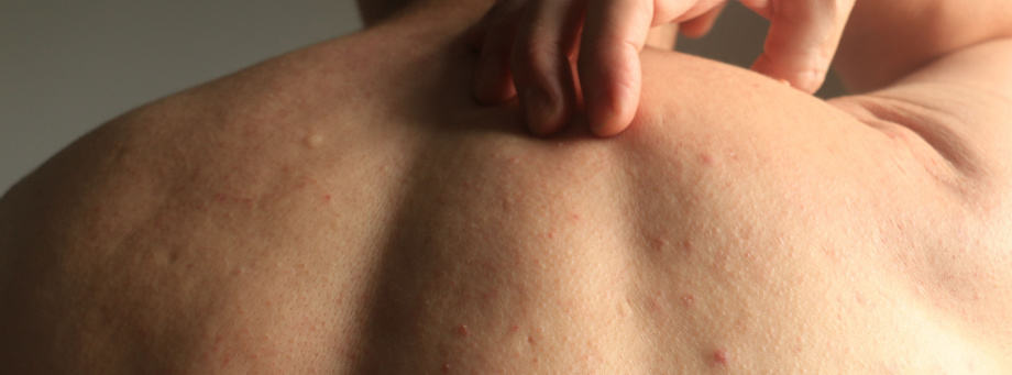 Comment éviter et traiter les boutons de sudation