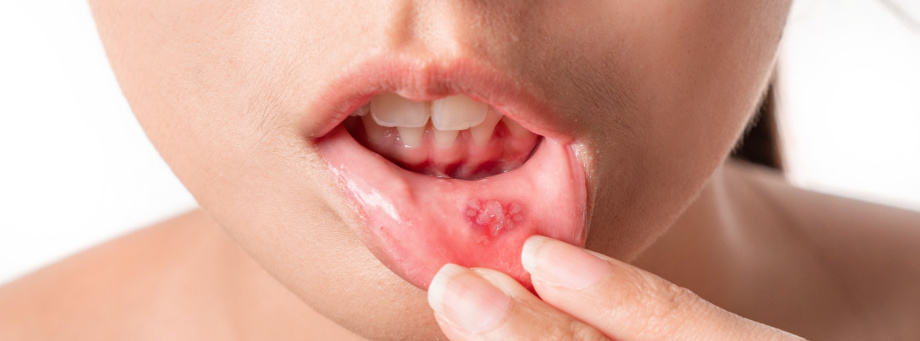 Aften in de mond: tips voor behandeling en verlichting